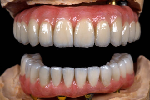 LUCRARI PROTETICE PERSONALIZATE