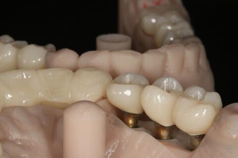 LUCRARI PROTETICE PE IMPLANT